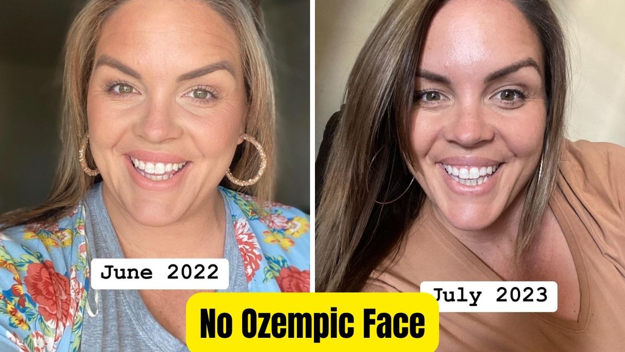 ozempic face before and after pictures